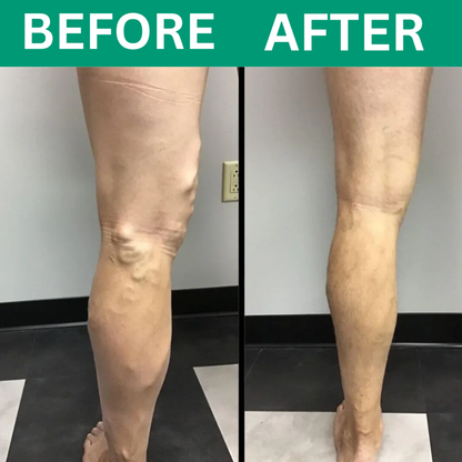 Revivo™ 3-in-1 Leg Massager For Varicose Veins