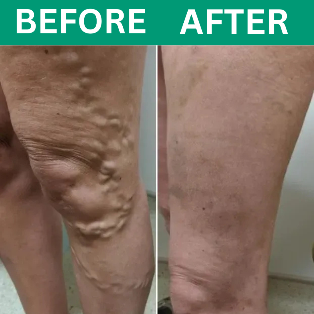 Revivo™ 3-in-1 Leg Massager For Varicose Veins