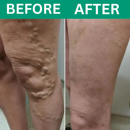 Revivo™ 3-in-1 Leg Massager For Varicose Veins