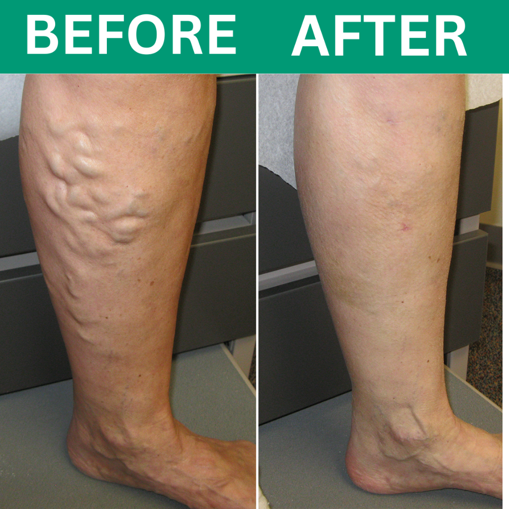 Revivo™ 3-in-1 Leg Massager For Varicose Veins