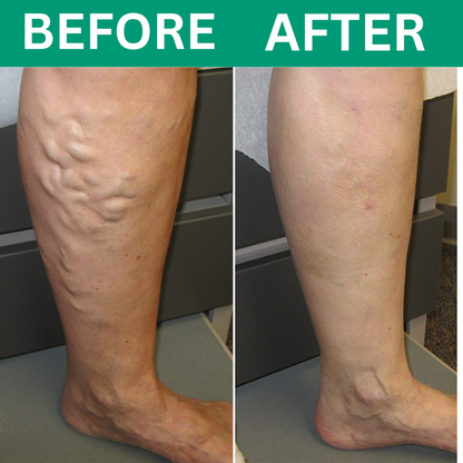 Revivo™ 3-in-1 Leg Massager For Varicose Veins