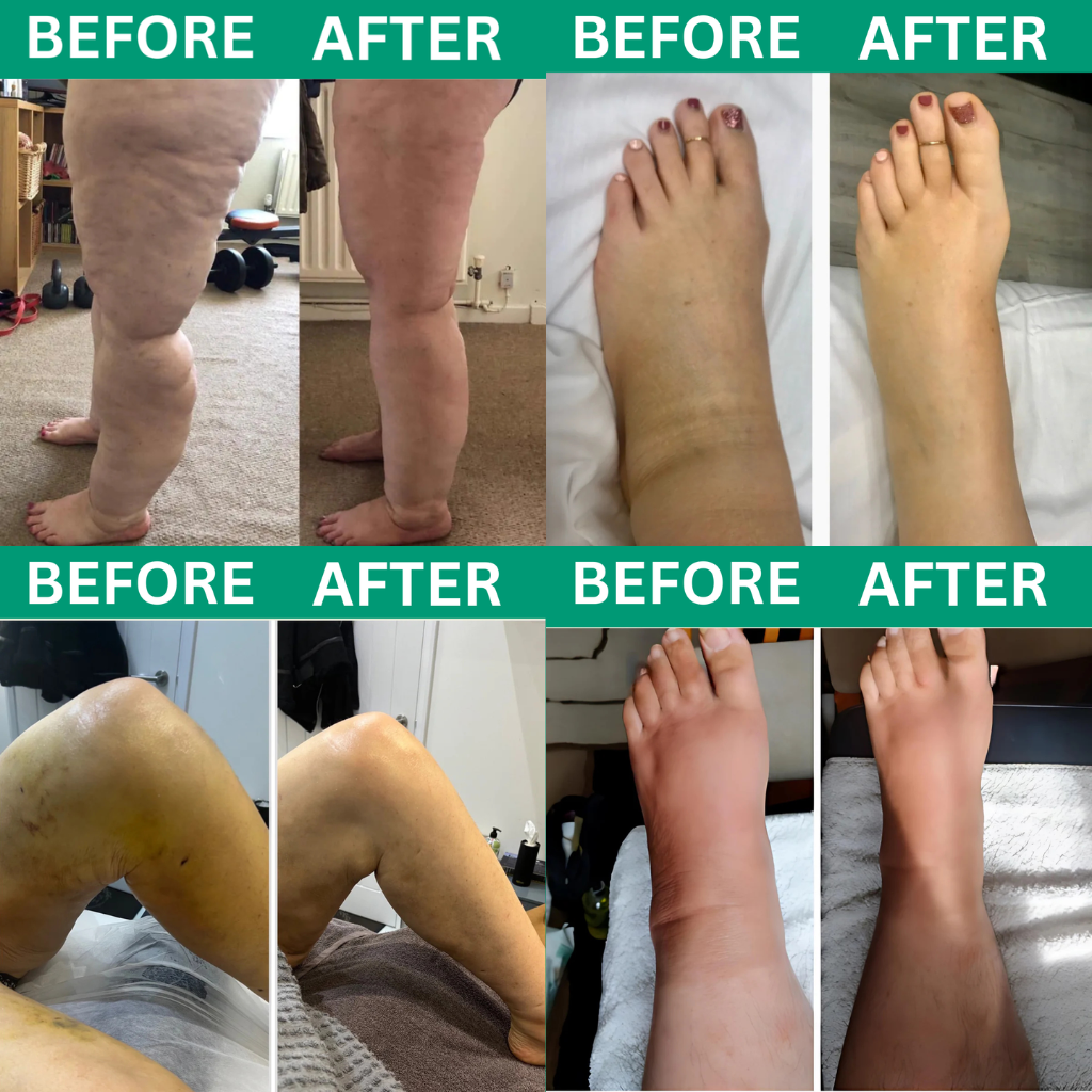 Revivo Leg Massager before and after swelling reduction