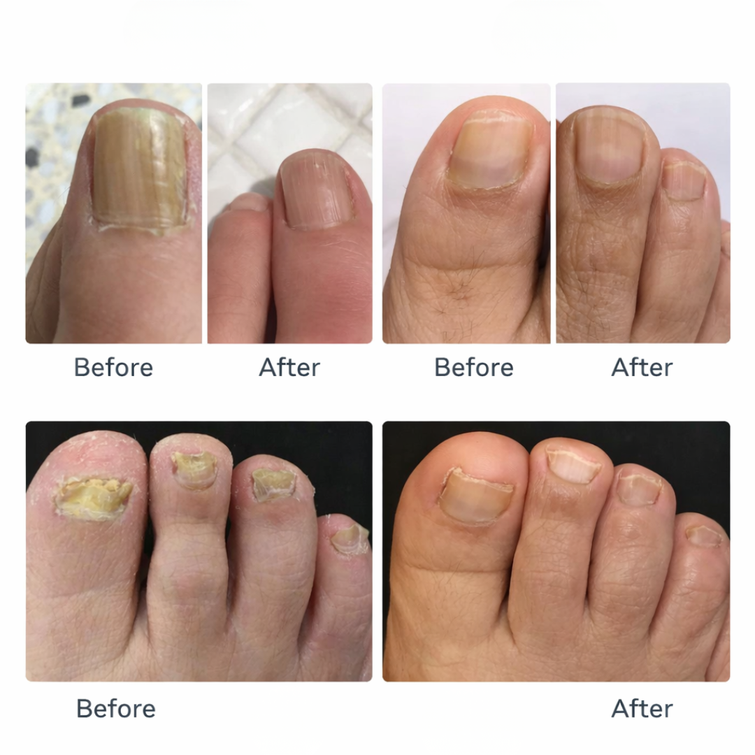 Luminail™ | Lichttherapie für zu Hause gegen Nagelpilz
